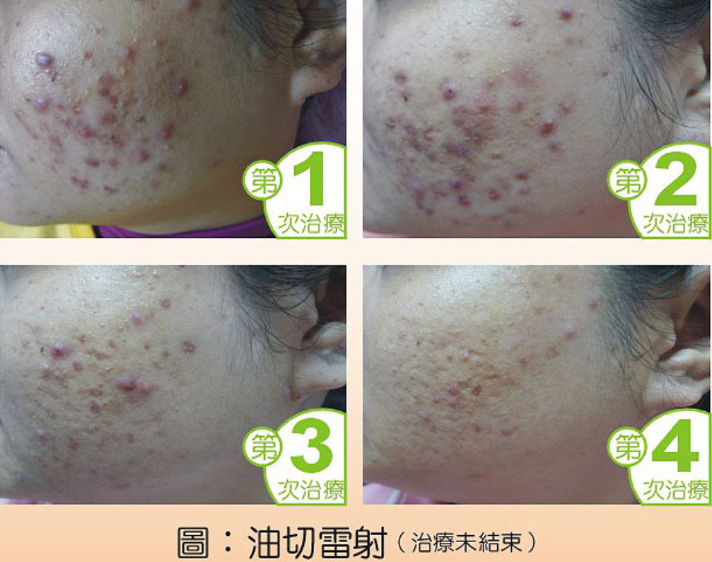 只要青春不要痘--淺談青春痘治療