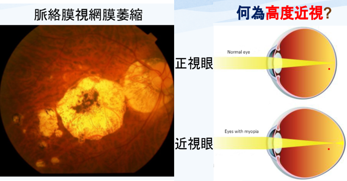 高度近視