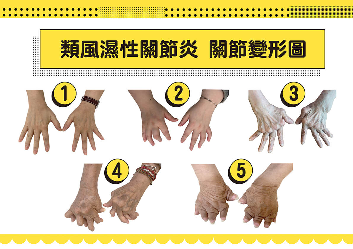 財團法人風濕性基金會台灣抗風濕病聯盟執行長暨台北榮民總醫院過敏免疫風濕科蔡長祐主任