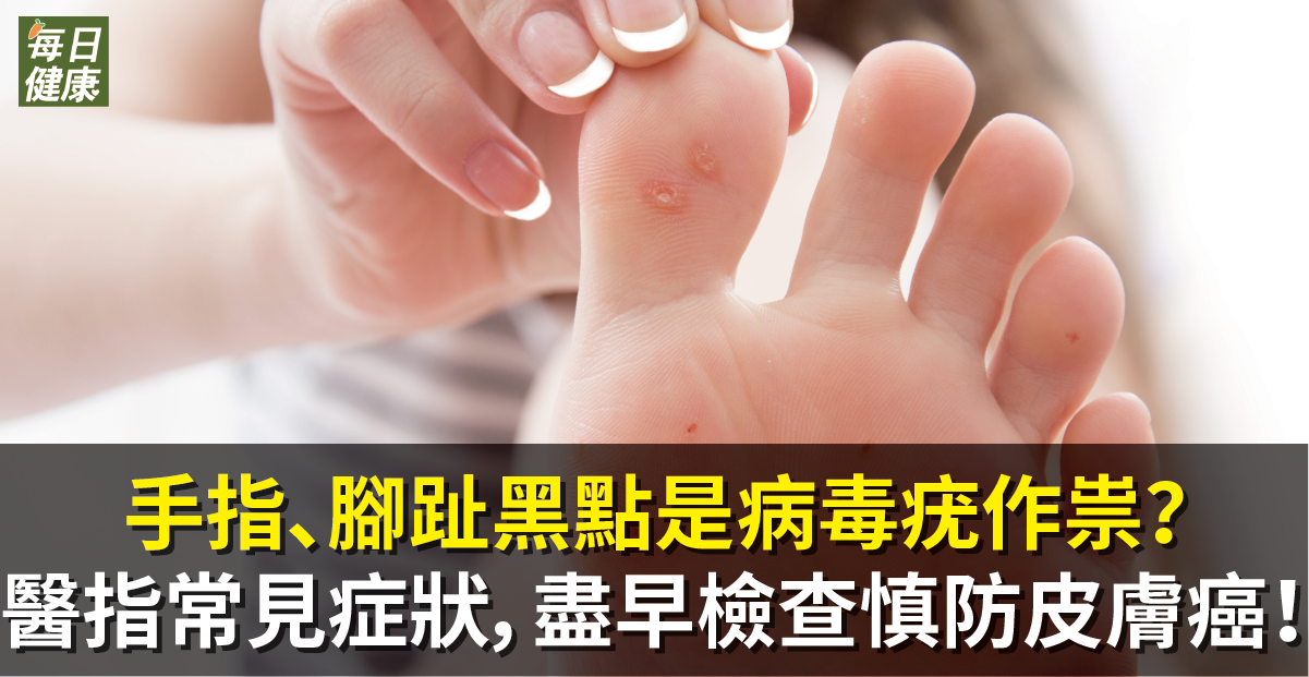 手指、腳趾黑點是病毒疣作祟？醫指常見症狀，盡早檢查慎防皮膚癌！