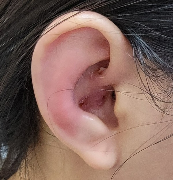 女子耳朵灼熱疼痛起水泡誤當蚊蟲叮咬　檢查後醫揭：耳朵長「皮蛇」！