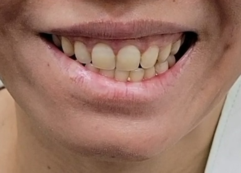 ▲右側嘴角動作偏斜,喝水時甚至有點滲漏/陳亮宇醫師 授權提供