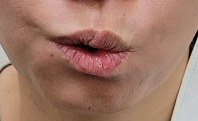 ▲右側嘴角動作偏斜,喝水時甚至有點滲漏/陳亮宇醫師 授權提供