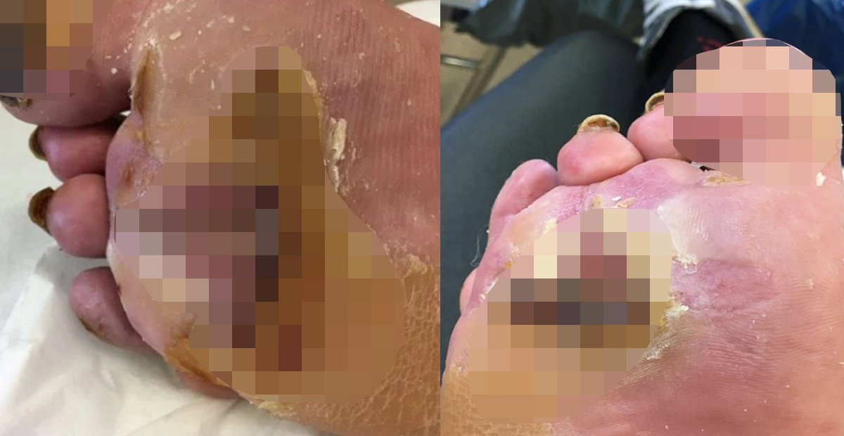 http://metro.co.uk/2017/11/16/mans-foot-save-by-maggots-after-he-burned-it-on-a-radiator-7084084/