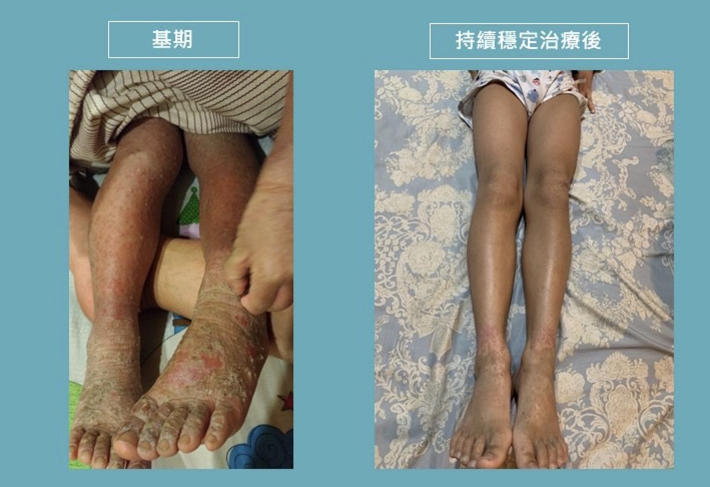 台灣兒童過敏氣喘免疫及風溼病醫學會提供